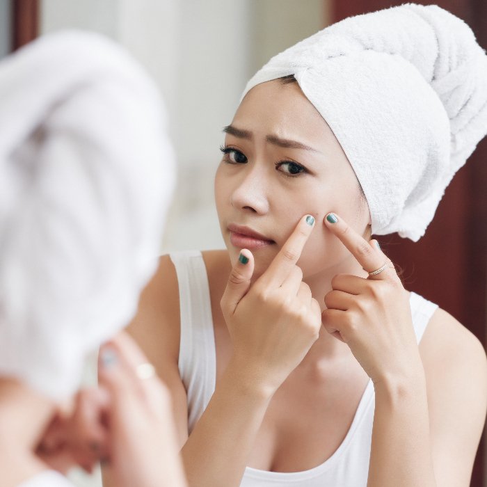 What is acne-prone skin?